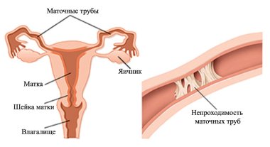 Признаки и симптомы непроходимости фаллопиевых труб