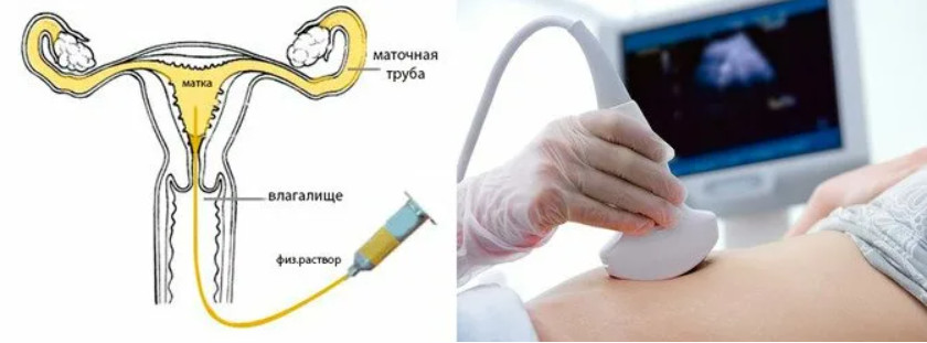 Фото: Диагностика непроходимости маточных труб