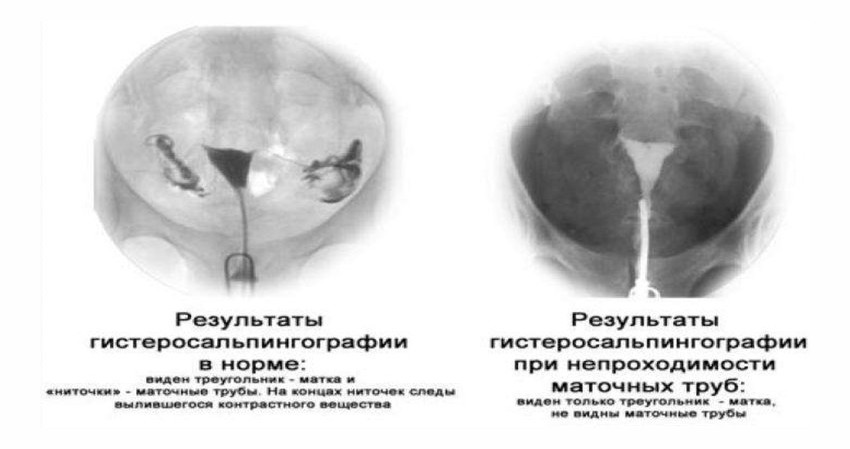 Фото: Диагностика спаек в маточных трубах