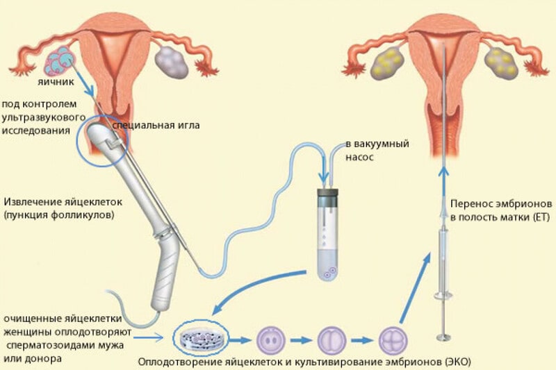 Фото: ЭКО при непроходимость маточных труб