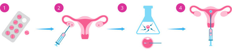 Фото: Этапы процедуры ЭКО