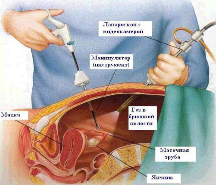 Фото: Лечение спаек в маточных трубах