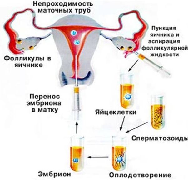 Фото: Лечение трубного бесплодия