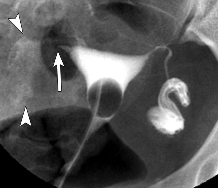 Фото: Как непроходимость маточных труб влияет на овуляцию?