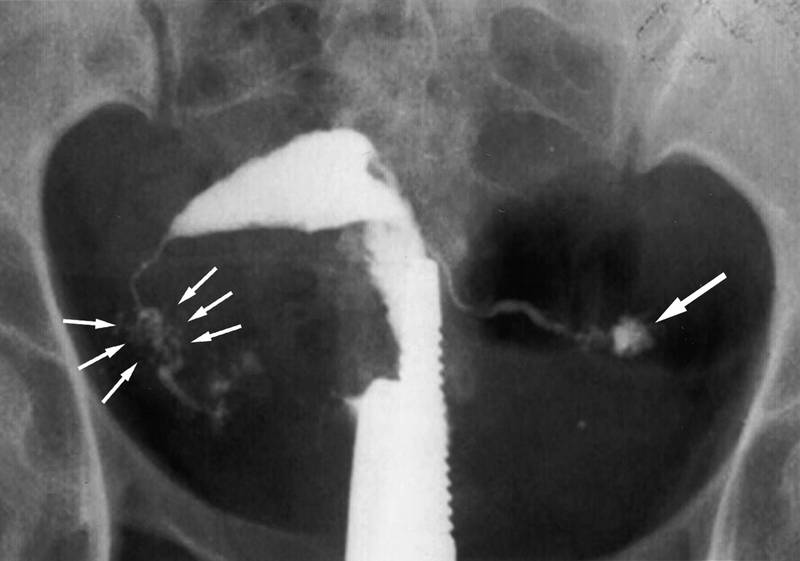 Фото: Проходимость маточных труб