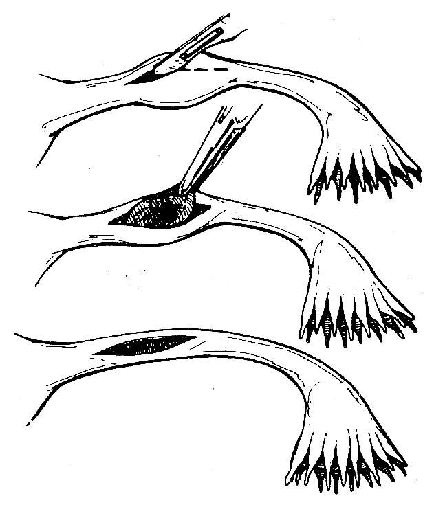 Фото: Сальпингостомия