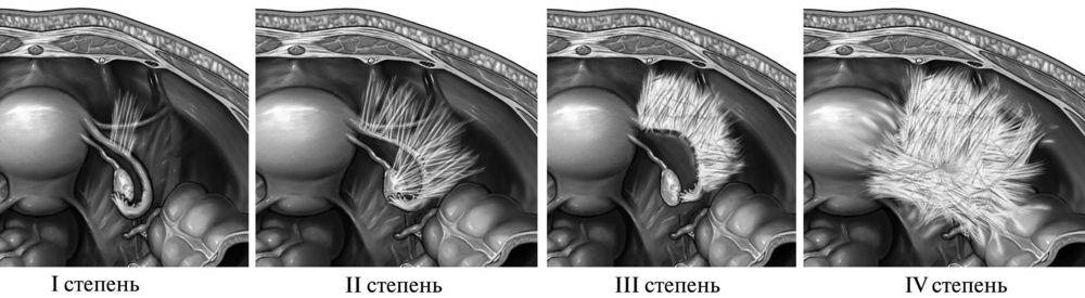Фото: Виды непроходимости маточных труб